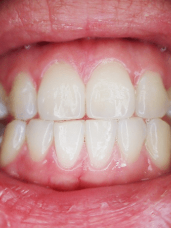 치과 치아미백 효과